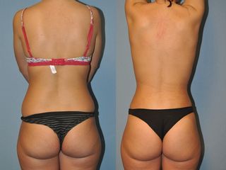 Antes y después Lipo espalda y flancos = 2700 €