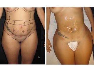 Antes y después Lipoescultura (marcaje de cintura)