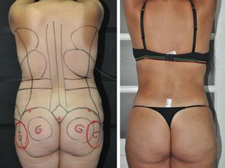 Antes y después Lipoescultura + injerto de grasa en glúteo