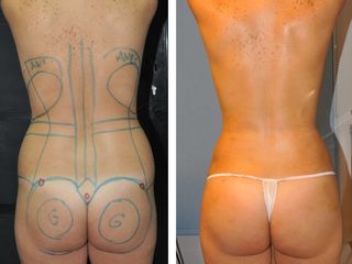 Antes y después Lipoescultura + injerto de grasa en glúteos