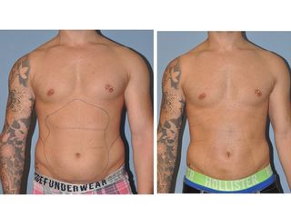 Antes y después Lipoescultura abdominal (10 días post.)
