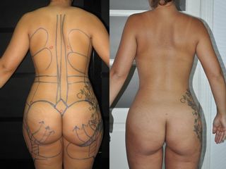 Antes y después Lipoescultura láser - Vaser
