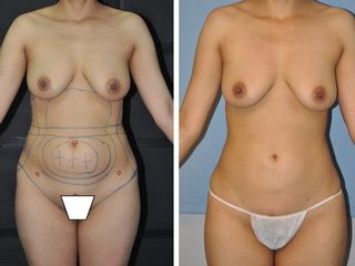 Antes y después Lipoescultura
