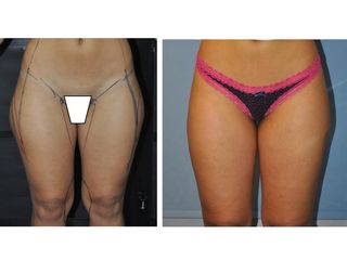 Antes y después Liposucción localizada Vaser