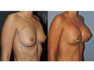 Antes y después Mamoplastia de aumento 380 cc