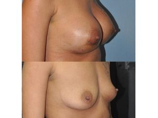 Antes y después Mamoplastia de aumento retromuscular
