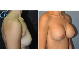 Antes y después Mamoplastia de aumento
