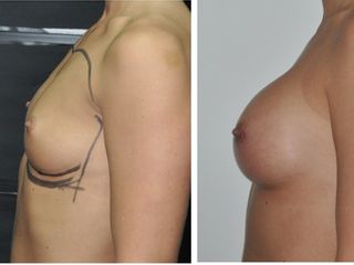 Antes y después Mamoplastia retro - muscular