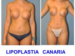 Antes y después Lipoescultura de alta definición muscular 