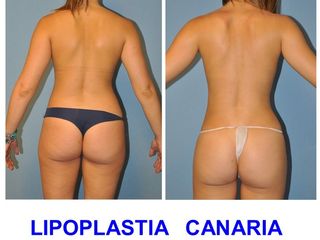 Antes y después Lipoescultura + aumento de longitud de espalda