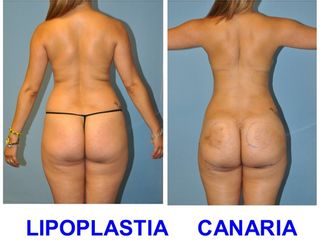 Antes y después Lipoescultura ( 1 semana despues del procedimiento )