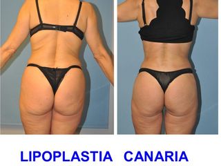 Antes y después Lipoescultura + Aumento de Gluteos