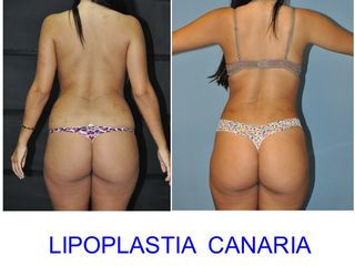 Antes y después Lipoescultura + aumento de longitud de espalda