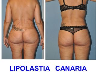 Antes y después Lipoescultura