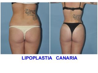 Antes y después Lipoescultura
