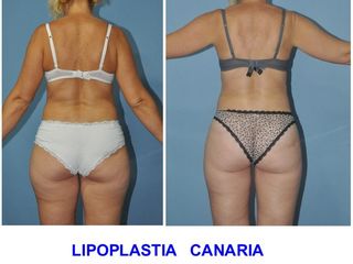 Antes y después Lipoescultura