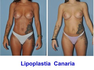 Antes y después Lipoescultura + Marcación Abdominal