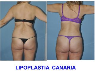 Antes y después LIPOESCULTURA  VASER