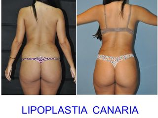 Antes y después LIPOESCULTURA  VASER