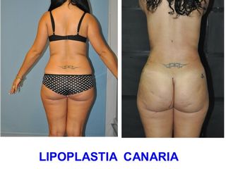 Antes y después LIPOESCULTURA  VASER