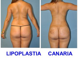 Antes y después LIPOESCULTURA  VASER