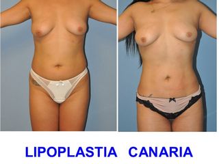 Antes y después LIPOESCULTURA  VASER