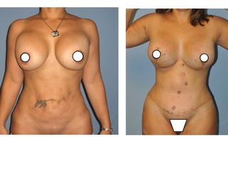 Antes y después ABDOMINOPLASTIA  +  MAMOPLASTIA