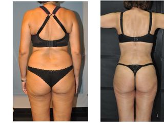 Antes y después LIPOESCULTURA  VASER