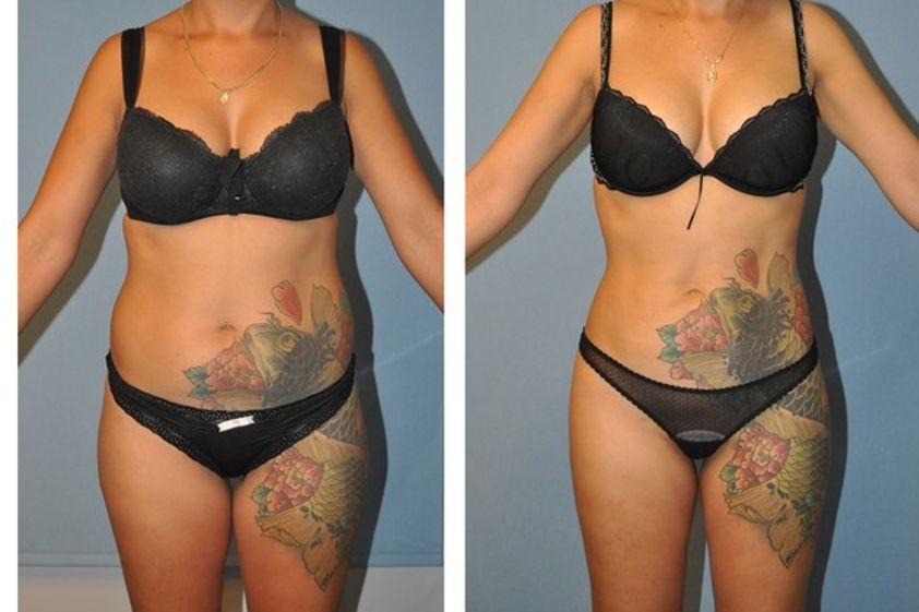 Lipo Vaser antes y después - 618817
