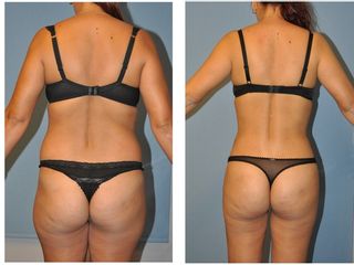 Antes y después LIPOESCULTURA  VASER