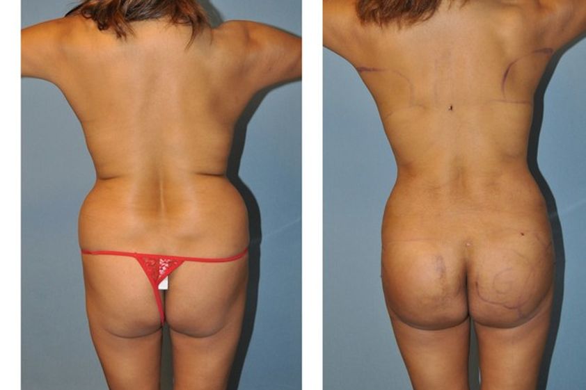 Lipoescultura antes y después - 618820