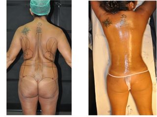 Antes y después LIPOESCULTURA