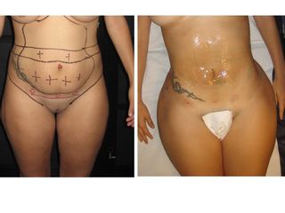 Antes y después LIPOESCULTURA  VASER