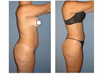 Antes y después LIPOESCULTURA