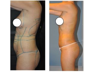 Antes y después LIPOESCULTURA  VASER