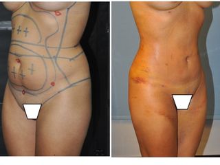 Antes y después LIPOESCULTURA