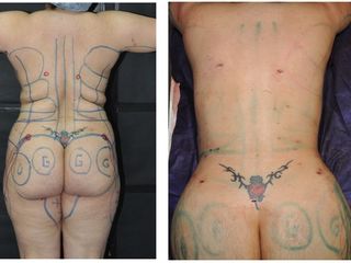Antes y después LIPOESCULTURA