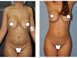 Antes y después LIPOESCULTURA