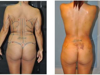 Antes y después LIPOESCULTURA