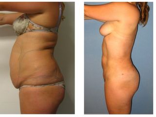 Antes y después LIPOESCULTURA