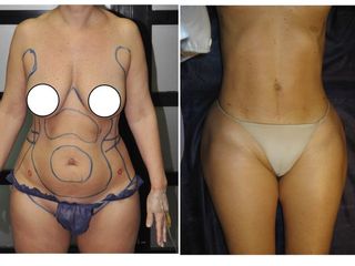 Antes y después LIPOESCULTURA  VASER