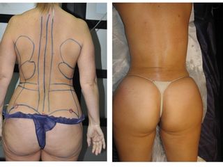 Antes y después GLUTEOS