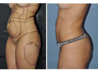 Antes y después LIPOESCULTURA