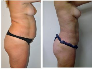 Antes y después LIPOESCULTURA + GLUTEOS