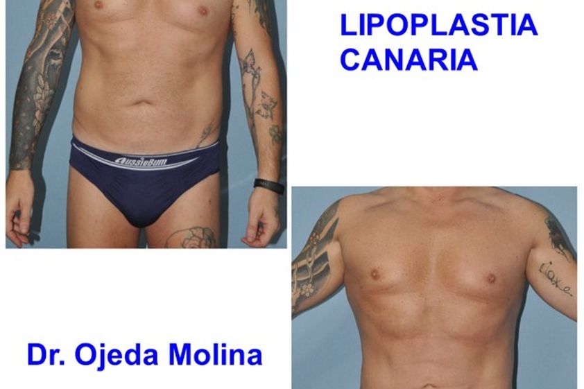 Marcación abdominal antes y después - 623287
