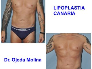Antes y después Marcacion Abdominal Masculina