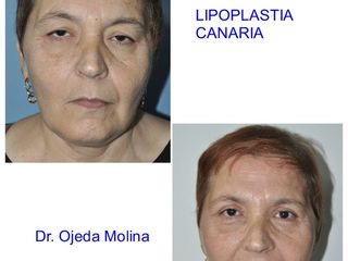 Antes y después Blefaroplastia Superior Bilateral