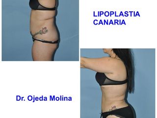 Antes y después Lipoescultura + Glúteos