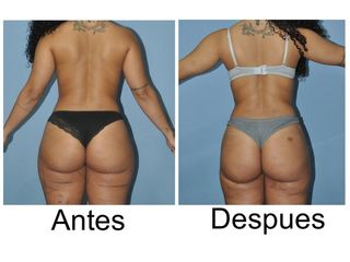 Antes y después Lipoescultura + Glúteos