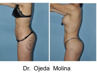 Antes y después Marcaje Abdominal + Moldeo glúteo